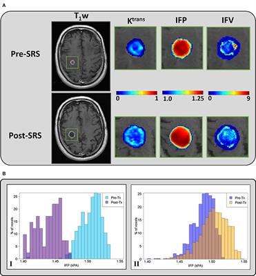 Computational Modeling of Interstitial Fluid Pressure and Velocity in Non-small Cell Lung Cancer Brain Metastases Treated With Stereotactic Radiosurgery